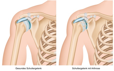 Arthrose in der Schulter