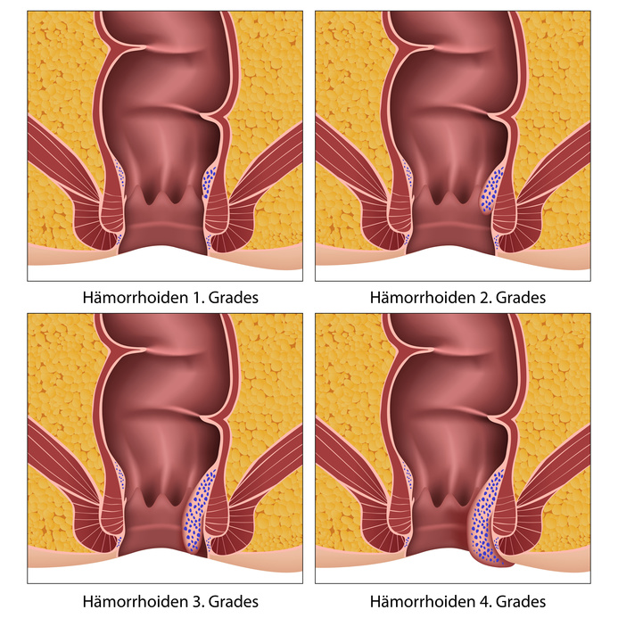 Hämorrhoiden Erkrankungsgrade