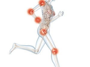 Frauen Zeichnung mit Arthrose