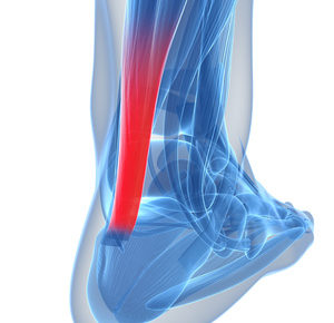 Tendinitis