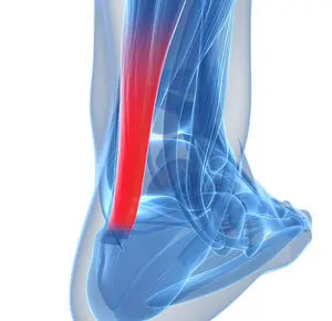Tendinitis