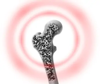 Osteoporose