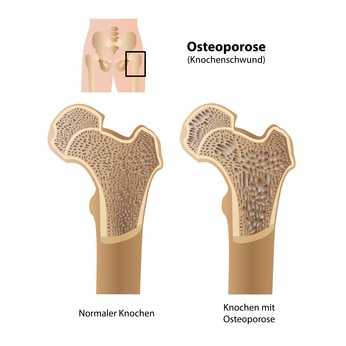 Knochenschwund Erklärung (Osteoporose)