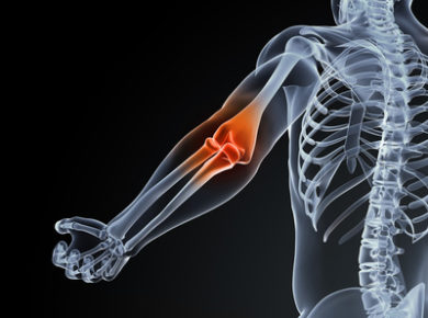 Bursitis im Ellenbogen