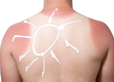 Sonnenbrand