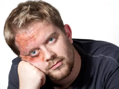 Gesichtsverbrennung
