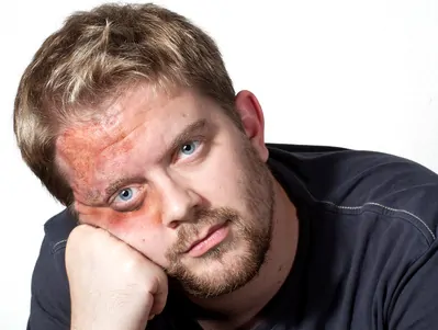 Gesichtsverbrennung
