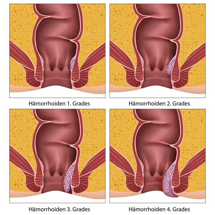 Hämorrhoiden Erkrankungsgrade