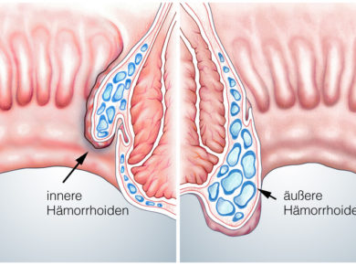 Hämorrhoiden Erklärung Schaubild