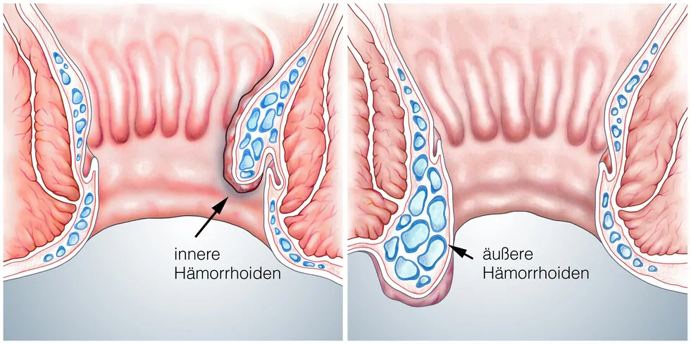 Hämorrhoiden Erklärung Schaubild