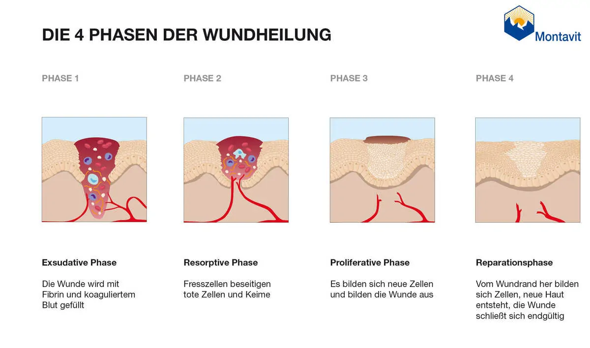 Wundheilung Phasen