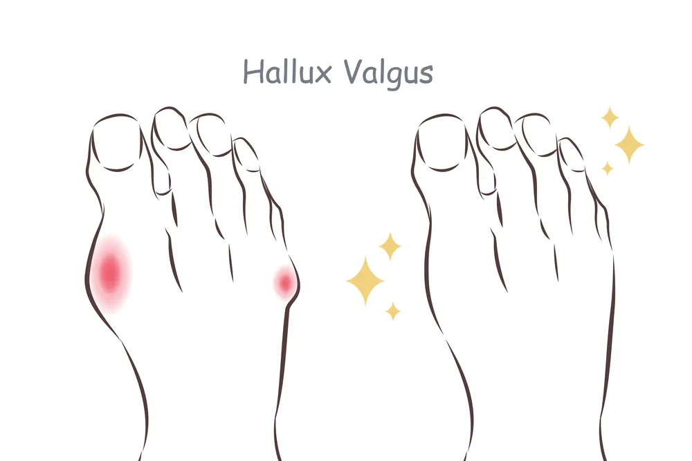 Hallux Valgus