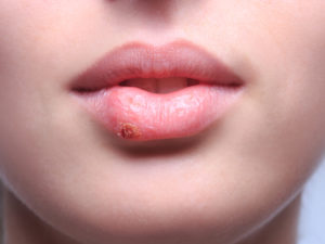 Frau mit Herpes an der Lippe