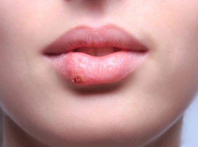 Frau mit Herpes an der Lippe