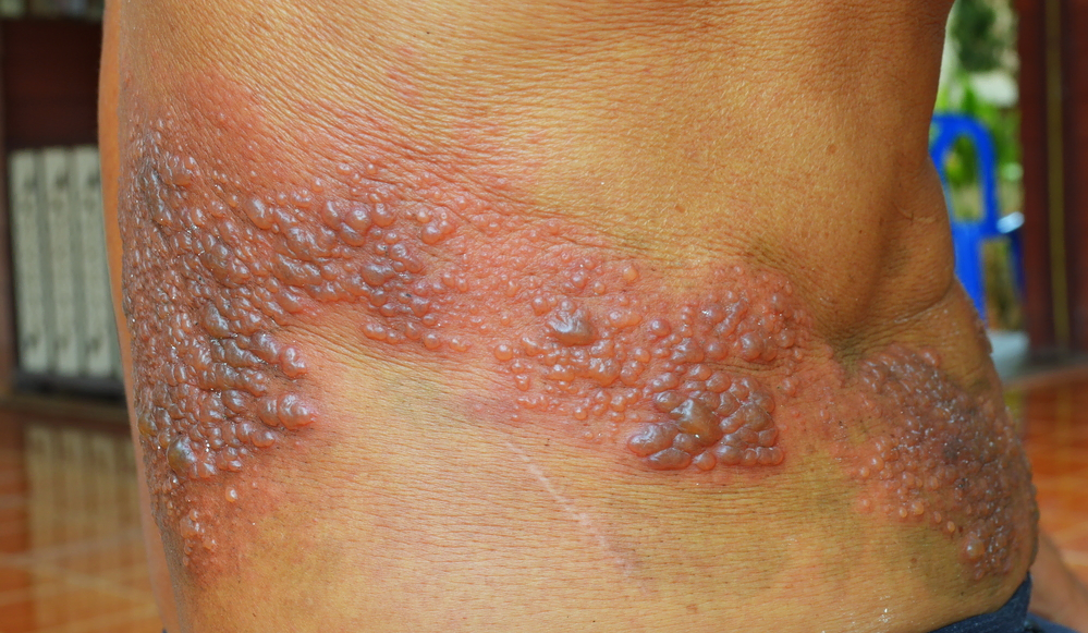 Herpes Infektion