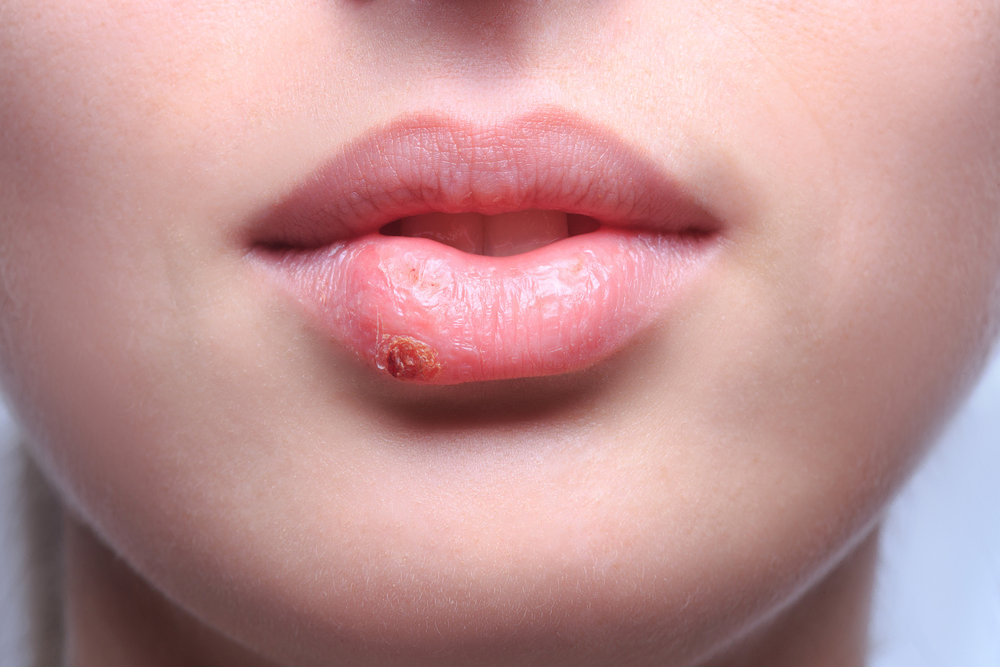 Frau mit Herpes an der Lippe