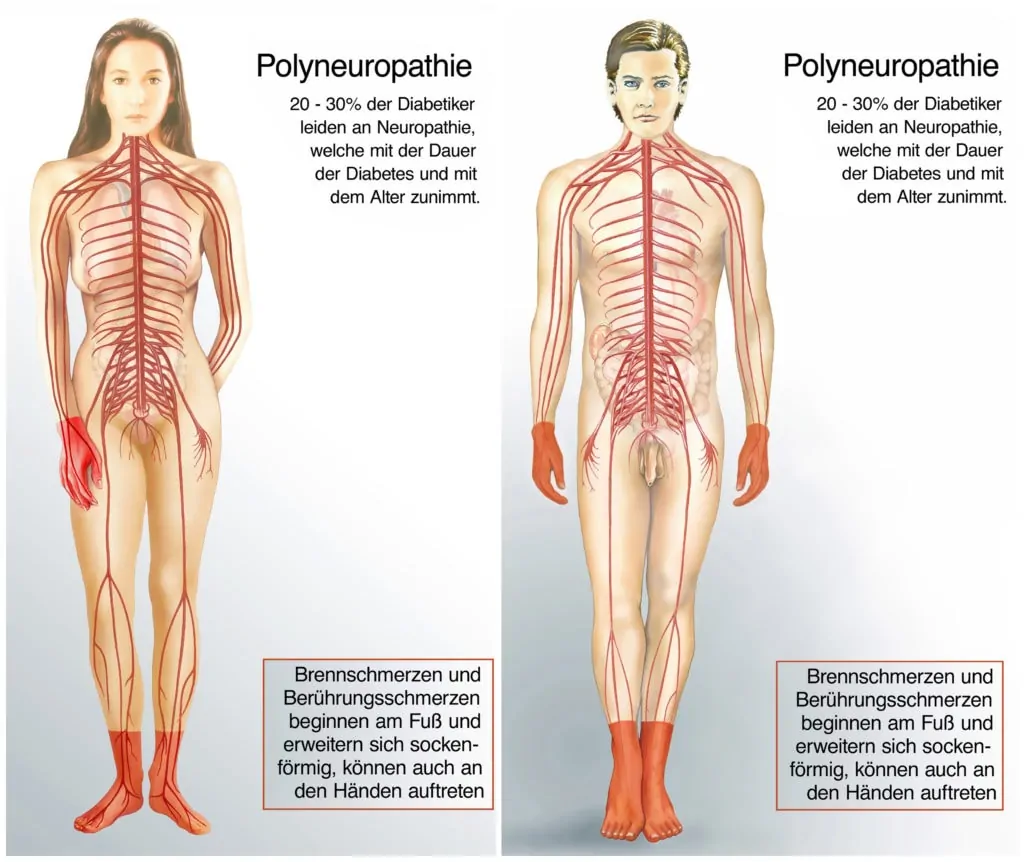 Polyneuropathie: Neuropathie Folgeschäden bei Diabetes